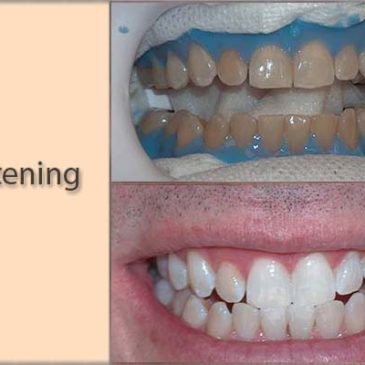 Techniques for Improving Your Smile