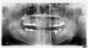 The Importance of Dental X-Rays