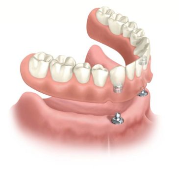 Overdentures: A Stronger Alternative to Dentures