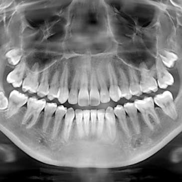 Dental X-Rays